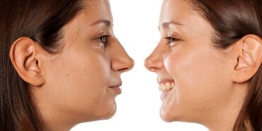 Sivas burun estetiği (2)