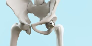 kalça protezi ameliyatı (2)